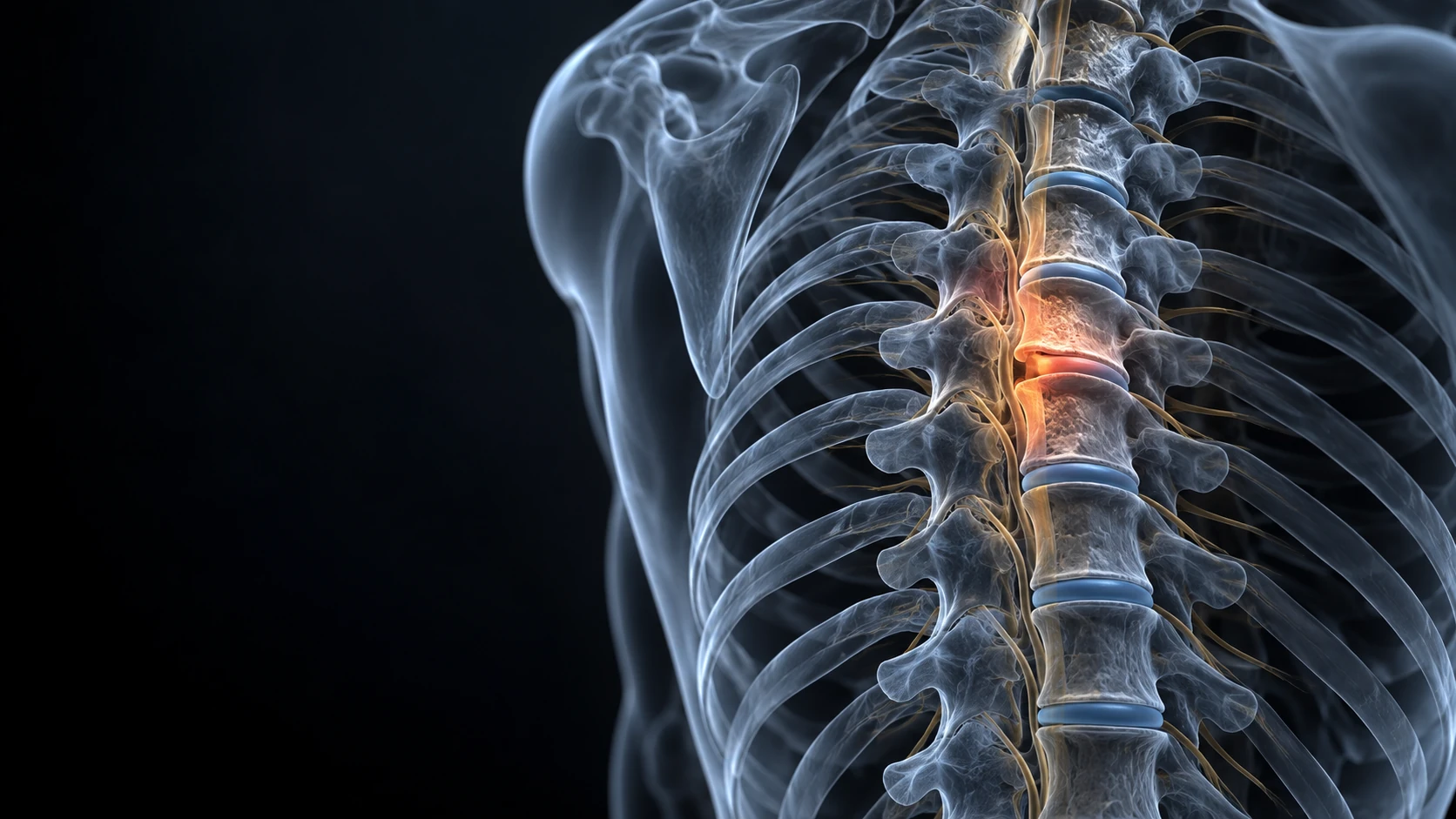 Conceptual illustration of thoracic disc disease in the mid-back